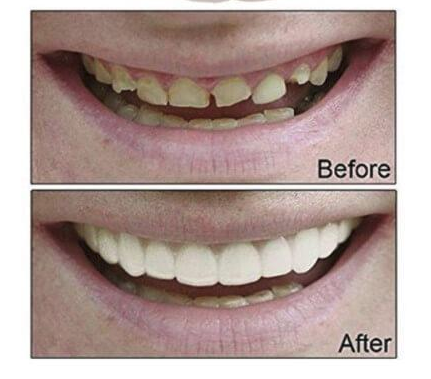 Perfect Teeth Veeners
