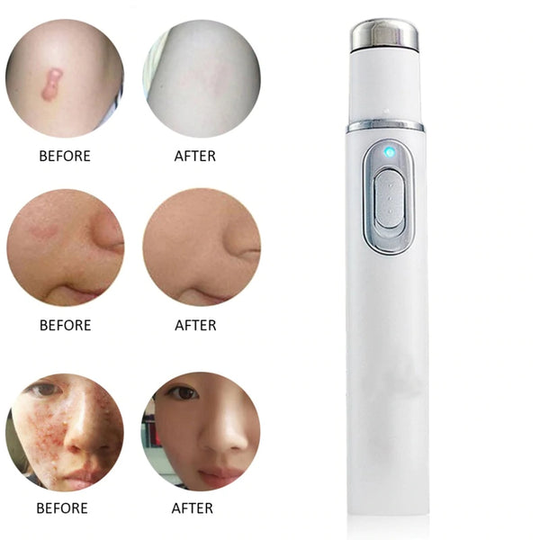 Acne Laser Pen Portable Wrinkle Removal Machine Durable Soft Scar Remover Blue Light Therapy Pen